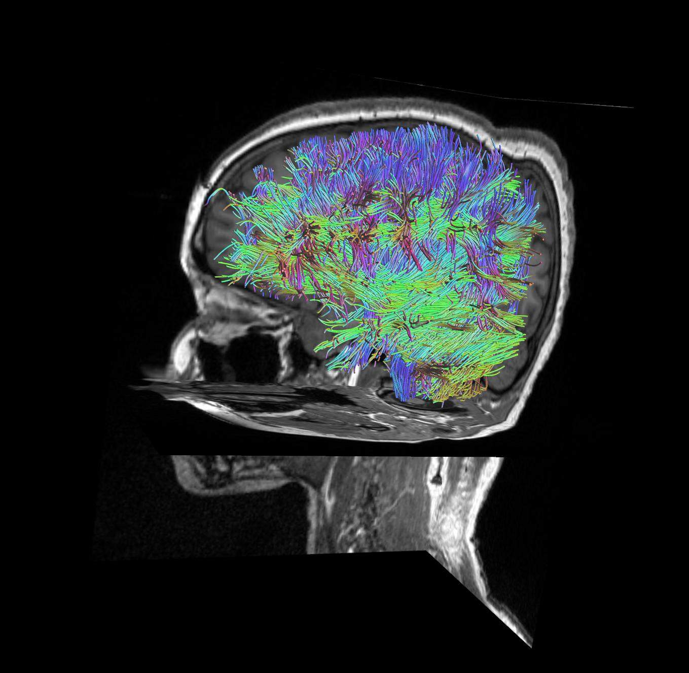 scan of a brain shown in bright colors